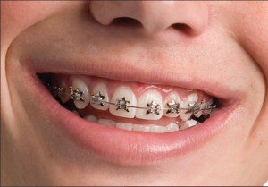 Smiling with braces